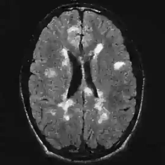 Multiple sclerosis | Neurology | Medicine