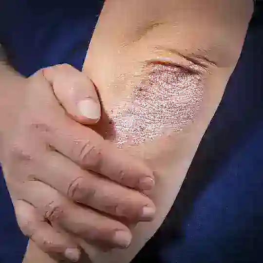 Псориатический артрит